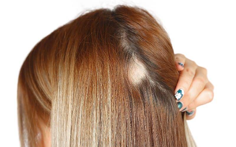 reverse traction alopecia