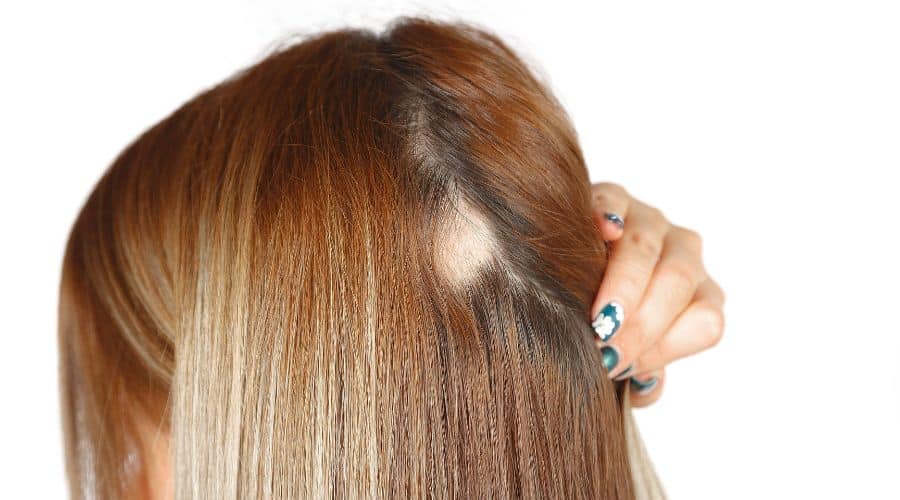 Traction Alopecia: Prevention and Reversal Strategies